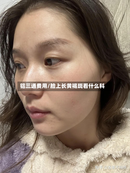 铝三通费用/脸上长黄褐斑看什么科