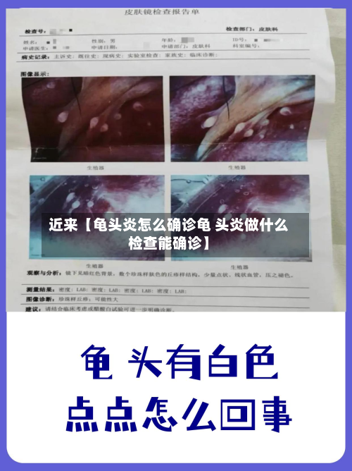 近来【龟头炎怎么确诊龟 头炎做什么检查能确诊】