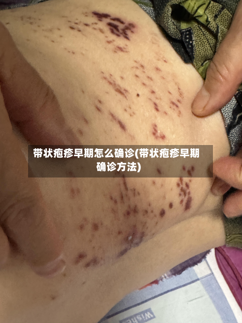 带状疱疹早期怎么确诊(带状疱疹早期确诊方法)